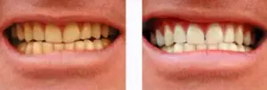 teeh whitening Stirling