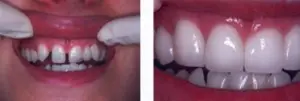 porcelain veneers