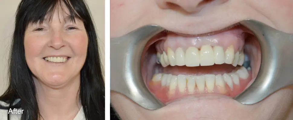 dental crowns