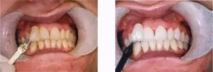 teeth whitening