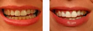 tooth whitening